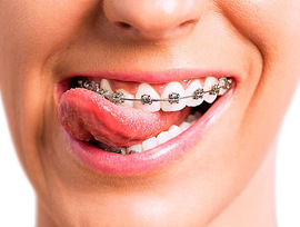 Top 10 Braces Systems